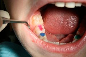 Пломбирование зубов – залог красивой улыбки ребенка