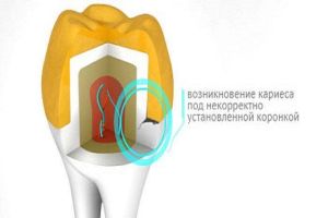 Болит зуб под коронкой: как лечить?