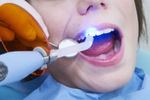 Пломбы на молочные зубы: виды пломбирующих материалов