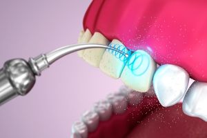Бережная белизна зубов с помощью ультразвука