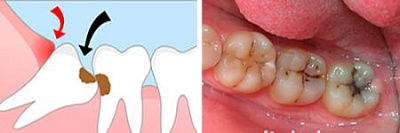 Безболезненное лечение зуба мудрости в стоматологической клинике «Берёзка»