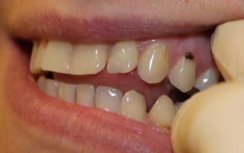 Основные стадии поражения зубов