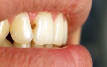 Избавление от кариеса передних зубов в клинике «Берёзка»
