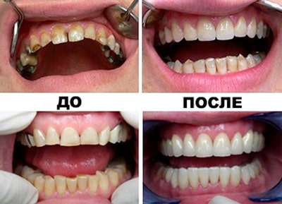 Примеры работ стоматологов «Березки» до и после установки коронок