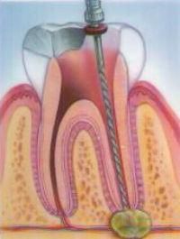 Основные типы гнойных образований на зубе
