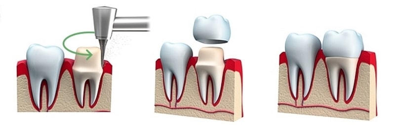 Нюансы установки протезов из металлокерамики: консультации стоматологов «Березки»