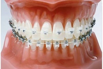 <ul> <li>сочетание систем лингвального и вестибулярного типа. На верхний зубной ряд устанавливается лингвальная конструкция, обладающая высшими эстетическими качествами, а на нижний – вестибулярная;</li> <li>применение разных материалов дли нижней и верхней челюстей. Такой вариант используют в случаях, когда степень искривления зубных рядов разная. При этом металлические изделия крепят к зубам, которые требуют большего напряжения, а на остальные единицы зубного ряда фиксируют сапфировые или керамические пластинки;</li> <li>соединение в одной конструкции разных материалов. Одни зубы в челюстном ряду могут быть больше искривленными, а другие меньше. Комбинированная брекет система с разными составляющими позволяет одновременно достичь максимального эффекта лечение и выиграть на эстетичности конструкции. Отличным сочетанием здесь будет металл с искусственными сапфирами;</li> <li>усиление корректирующего устройства металлом. Если для исправления прикуса используется керамическая или пластиковая конструкция, то для уменьшения периода лечения пазы, предназначенные для фиксирования дуги, укрепляют медицинской высокопрочной сталью. Такое сочетание несколько понижает эстетические показатели, но скорость и эффективность терапии увеличиваются в разы.</li> </ul> <p>Какой из вариантов использовать пациенту может определить только квалифицированный ортодонт, учитывая при этом степень сложности патологии и индивидуальные особенности конкретного человека.</p>