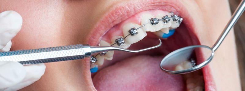 Ортодонтия зубов в Балашихе от врачей-стоматологов клиники «Берёзка»