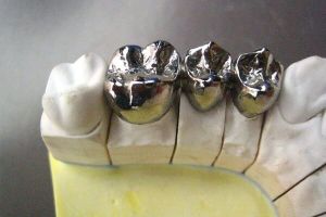 Детское протезирование стоматологами «Березки»