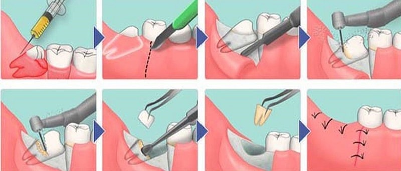 Зуб с разъединенными корнями: особенности операции