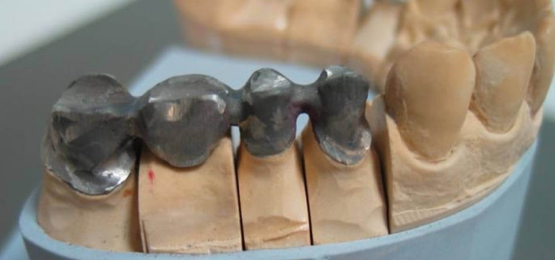 Установка коронки на зуб