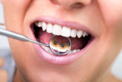 Ортодонтия зубов в Балашихе от врачей-стоматологов клиники «Берёзка»
