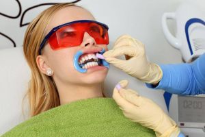Химическое отбеливание зубов: быстро, результативно, недорого
