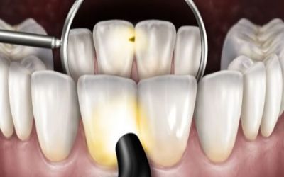 Лечение кариеса на передних зубах на ранних стадиях