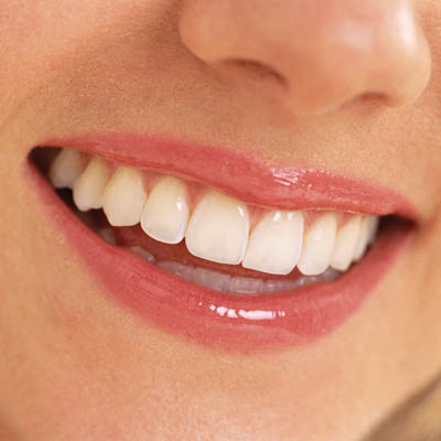 Отбеливание зубов: преимущества виниров