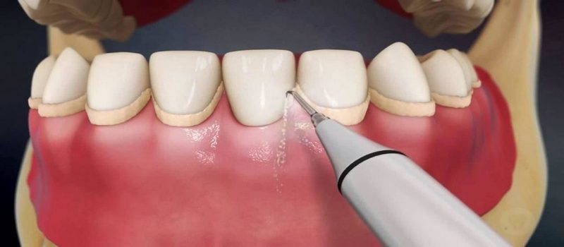 Ультразвуковая чистка зубного камня
