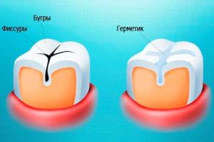 Лечение фиссурного кариеса в стоматологической клинике «Берёзка»