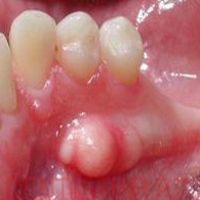 Удаление экзостозов полости рта в стоматологическом центре «Берёзка»