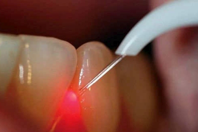 Стоматологическая хирургия: применение лазера