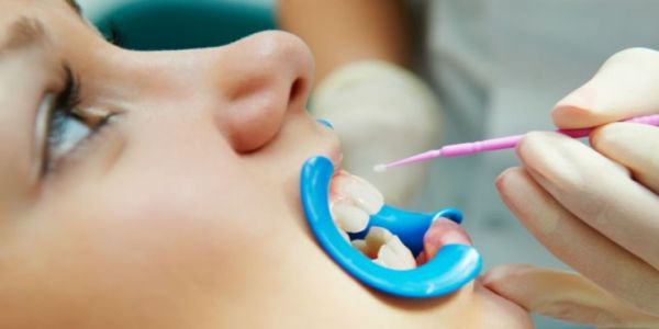 Фторирование молочных зубов как альтернатива серебрению