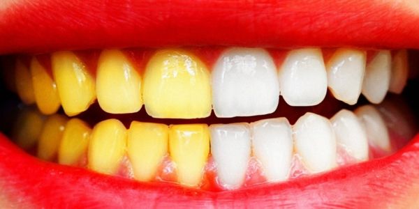 Преимущества осветления зубов химическим методом