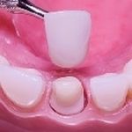 Снятие коронок с зубов: причины и способы извлечения
