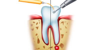 Гемисекция корня зуба – цена качества в стоматологической клинике «Берёзка»