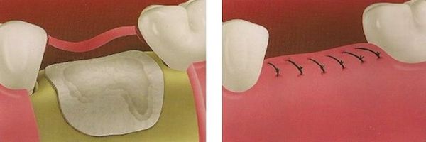Сложное изъятие 8-го зуба: причины