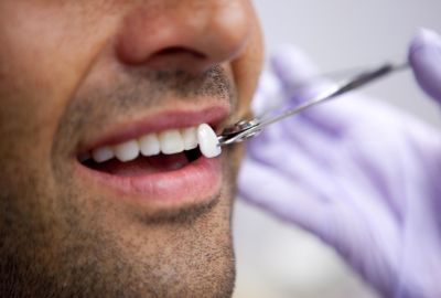 Исправление зубов винирами стоматологами клиники «Березка»