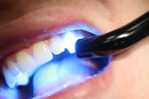 Тренд в отбеливании зубной эмали – лампы с холодным светом