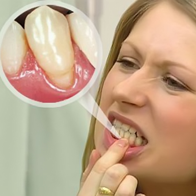 Чистка зубного камня