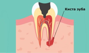 Цистоэктомия – операция по удалению кисты из полости рта